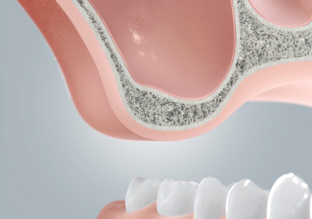 Zahnimplantat Knochenaufbau vor der Implantation